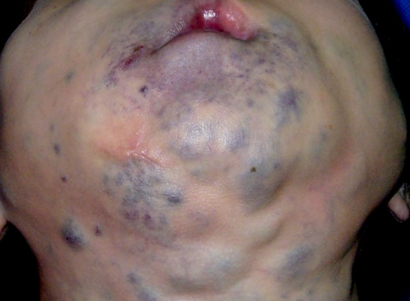 婴儿得了血管瘤严重吗?这6种危害影响宝宝一生